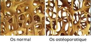 os normal vs os ostéoporotique