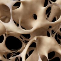 Vue os ostéoporotique