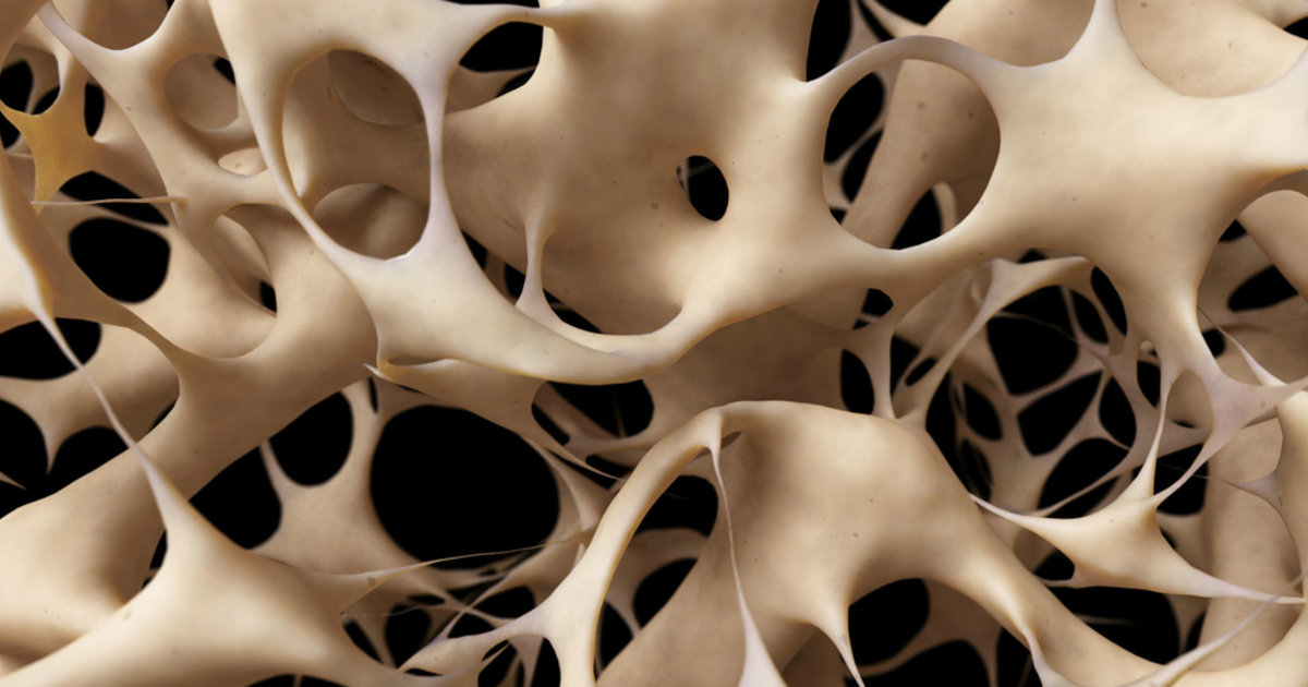 Vue os ostéoporotique